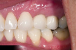 Dental Bridges After