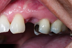 Dental Bridges Before