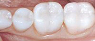 Teeth Inlay After