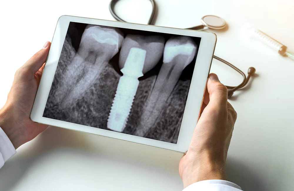 Dentist watching a dental x-ray teeth with dental pivot on digital tablet.