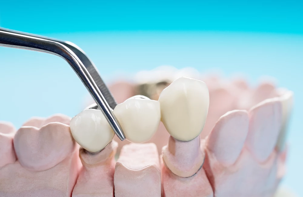 Closeup / Prosthodontics or Prosthetic / Teeth crown and bridge implant dentistry equipment